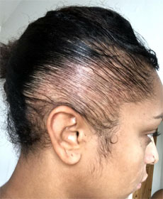 Singer Paigey Cakey went public with her traction alopecia